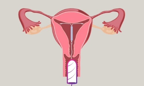 tampons with an Intrauterine device inserted